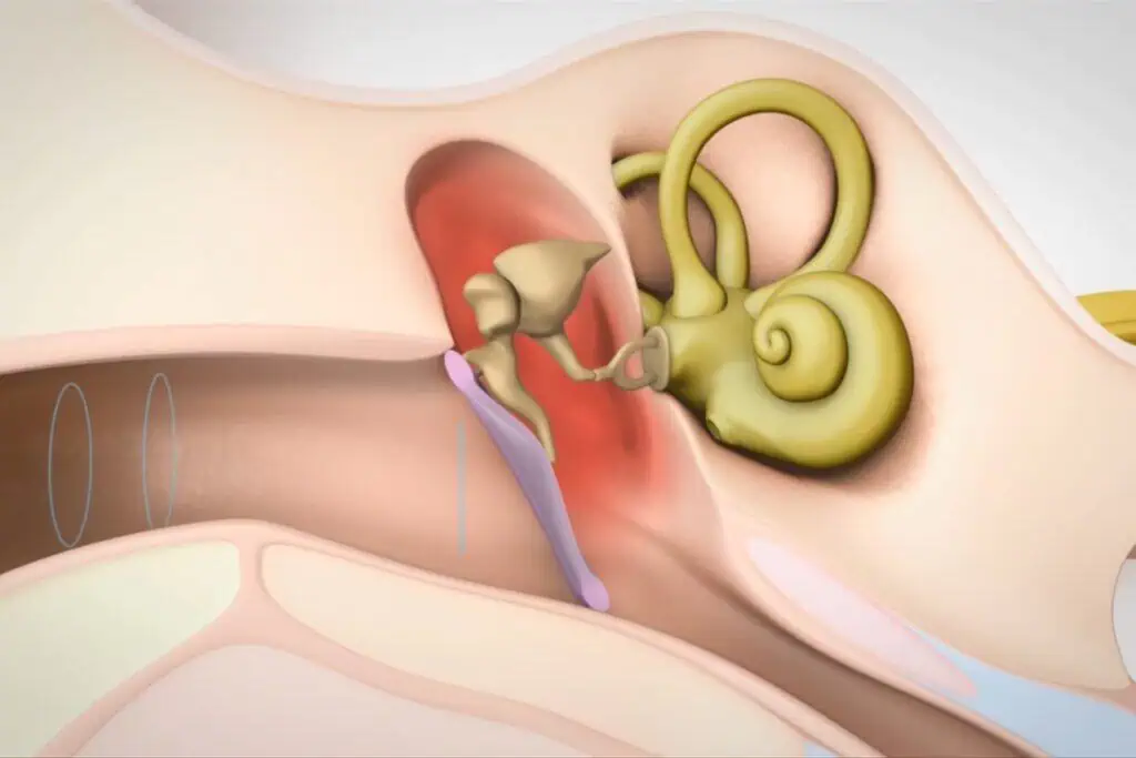 Audiogram Analysis
